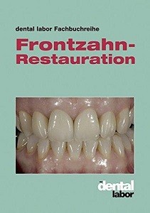 frontzahnrestauration
